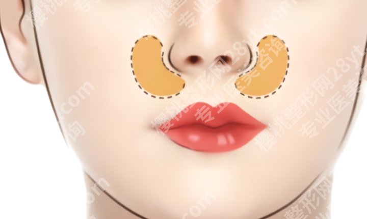 上海九院鼻基底凹陷peek材料多少钱？一般可以维持多久呢？