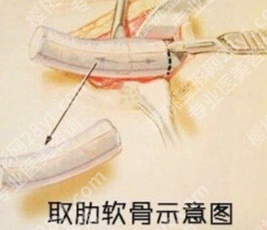 广州韩妃整形隆鼻哪个医生好？李军军实操鼻部整形案例分享！