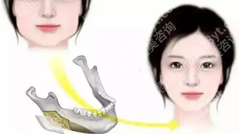 华西医院磨骨手术价格多少？医院简介及相关科普知识！