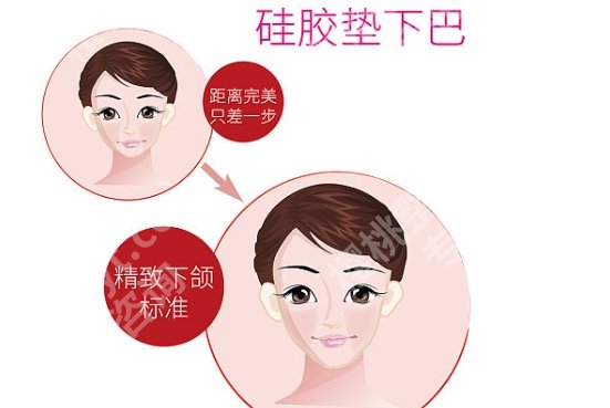 上海九院垫下巴多少钱？医院具体详细介绍！附相关科普知识