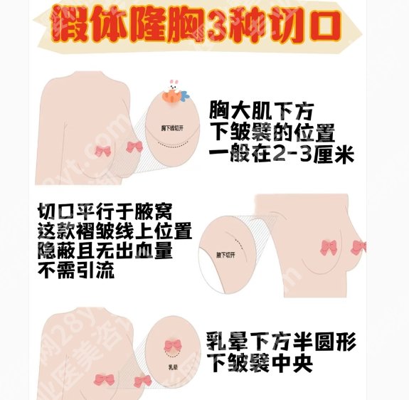 广州南方医院隆胸怎么样？医院技术实力雄厚！案例鉴赏