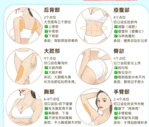 南方医院整形科真实案例:吸脂经验在线分享！附2025价格表