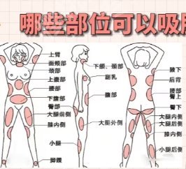 广州吸脂医生排名有哪些？医生具体内容介绍！