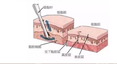 上海抽脂修复医院排名详情!前五机构实力评出!