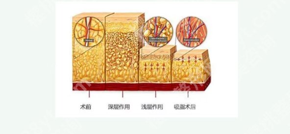 金华吸脂专家排名前十名单！院内实力医生简介！擅长再看