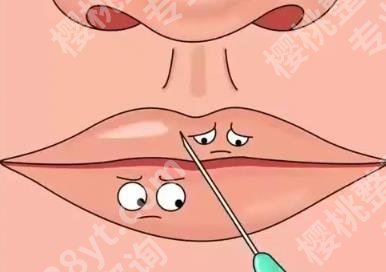 嘉兴丰唇一般需要多少钱?可维持多久?口碑医院推荐!