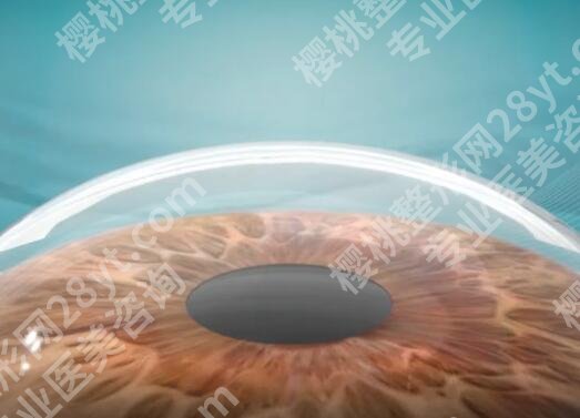 宁波做近视眼手术价格多少？全飞秒近视眼矫正费用大概在18000元