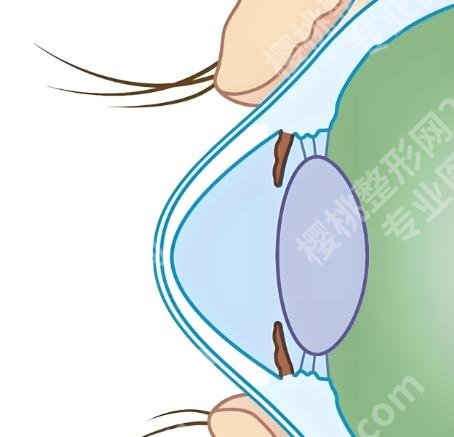 宁波做近视眼手术价格多少？全飞秒近视眼矫正费用大概在18000元