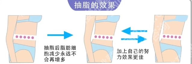 闫伦医生抽脂技术怎么样？吸脂手术案例鉴赏！