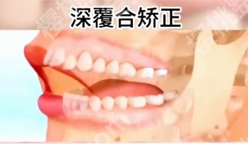 长春深覆合矫正多少钱？分享了具体的价格表参考！