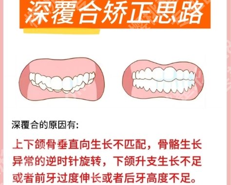 长春深覆合矫正多少钱？分享了具体的价格表参考！
