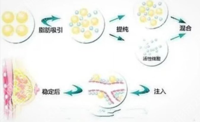 北京八大处自体脂肪隆胸多少钱？2025近期价格信息表参考！