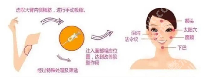 上海九院脂肪填充全脸多少钱？近期价格表明细参考！速速码住
