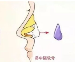 北京八大处隆鼻多少钱怎么样？医院技术优势！项目推荐