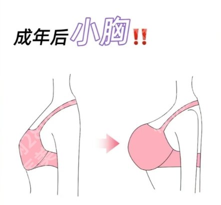 罗志敏医生隆胸案例图片展示！来看前后差别大不大吧！