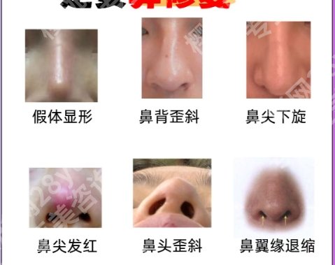 武汉同济医院歪鼻手术费用贵不贵?多少钱?案例图鉴赏!
