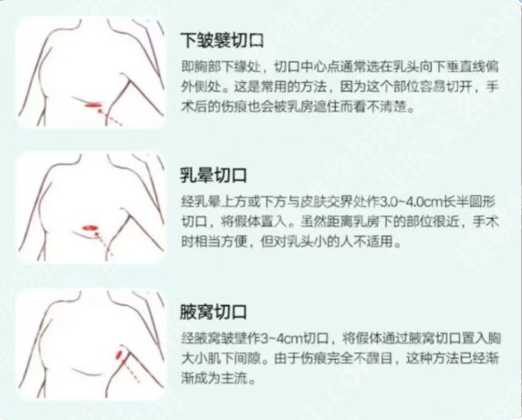 南方医院脂脂肪丰胸怎么样？医院技术力量雄厚！环境优雅温馨