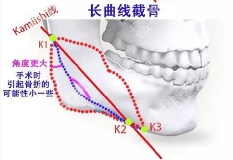 山东省立医院磨骨手术价格透明！医院核心项目详情！