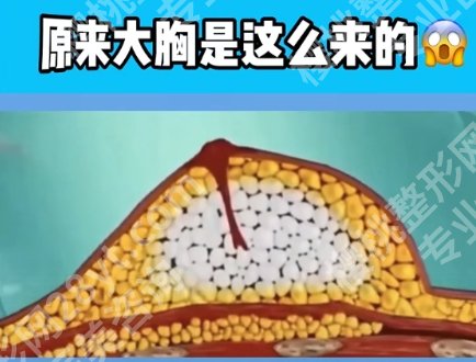 马腾医生会做内窥镜隆胸吗？效果好不好？经典案例反馈！