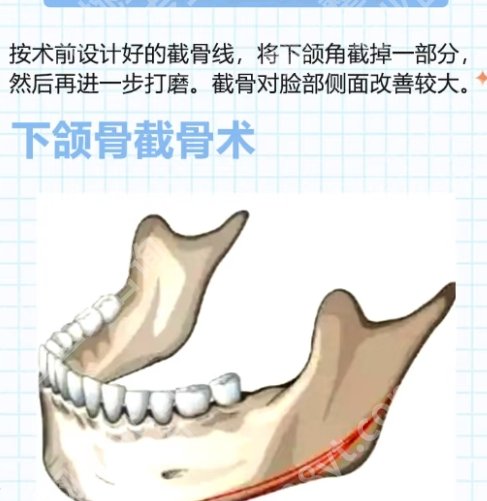黄大勇颧骨颧弓两件套多少钱？医生擅长项目简介！