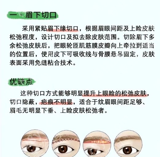 广州韩妃做提眉*好的医生？挂号攻略|案例分享！