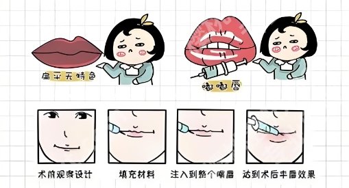 上海玻尿酸丰唇需要多少钱？医院价格表单新鲜出炉！