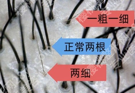 郑州植发医院哪家好？医院技术精湛内部环境舒适优雅！