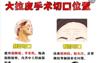 广医附一院拉皮手术费用贵不贵？技术优势剖析！点击一览