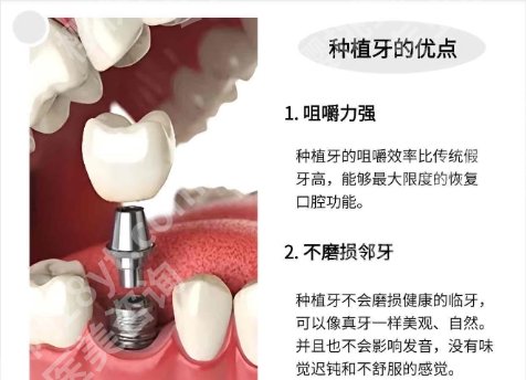 常州牙齿种植一般要多少钱？医院物美价廉！案例分享