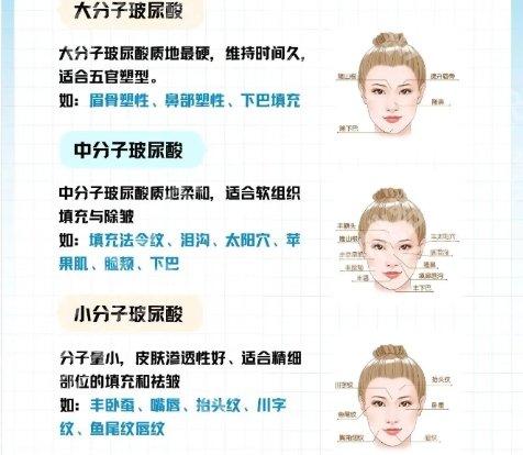 华西医院打玻尿酸怎么样？医院技术靠谱！案例分享