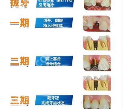 安阳市口腔医院种植牙价格贵不贵？收费标准更新！点击收藏