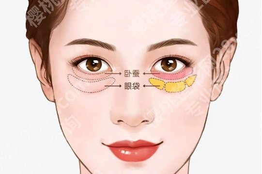 北医三院祛眼袋好吗？医院技术提升！口碑点评