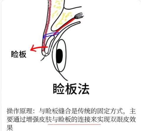 珠海割双眼皮多少钱？都是5000元左右起！价目表一览参考！