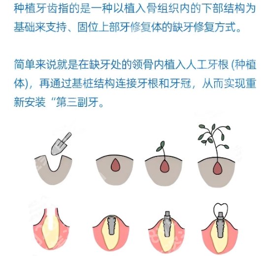 临沂种植牙哪里医院好？临沂市人民医院|中心医院等技术实力强！