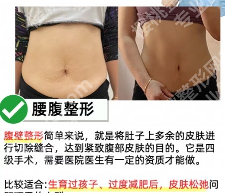 崔东医生腹壁成形范例分享！来看前后差别大不大吧！