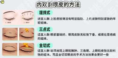 绍兴割双眼皮多少钱？医院考价格是13101元起！速速码住