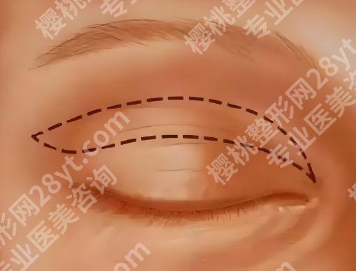 李天石双眼皮修复案例如何？看看案例详情吧