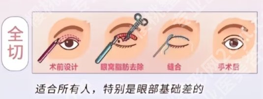 呼和浩特割双眼皮哪里好？医院人才实力都很雄厚！
