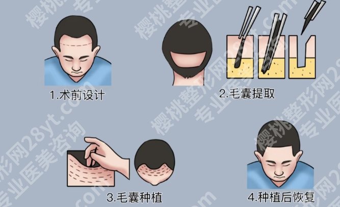 深圳植发医院哪个比较好？大麦微针连锁深圳总院|雍禾植发连锁等都很不错！
