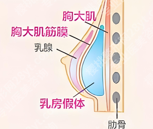 北京脂肪隆胸安全吗？注意事项和维持时间科普分享
