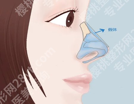 遂宁中心医院隆鼻怎么样？隆鼻案例和技术医生推荐