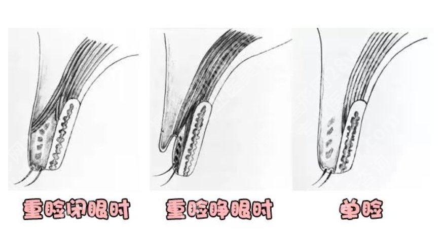 佀同帅全切双眼皮案例及医生具体资料！近期案例反馈！