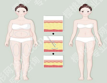 宁波腰腹吸脂医院哪家强？人气榜单资料更新