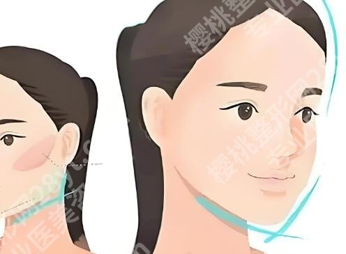颧骨内推恢复期多久？全流程揭秘，详情咨询在线看
