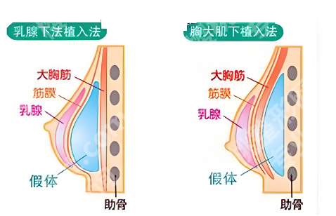 长沙假体隆胸好的医院医生技术如何？李雯/郭林林/文婷水平高
