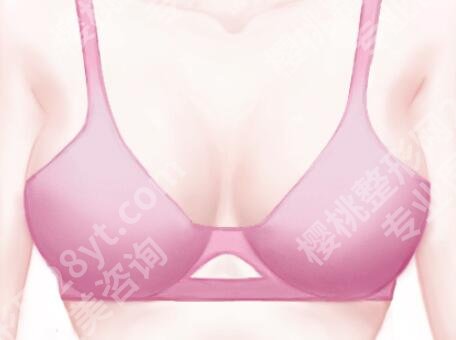 胸下垂矫正手术费用揭秘：从影响因素到各地参考价都有盘点
