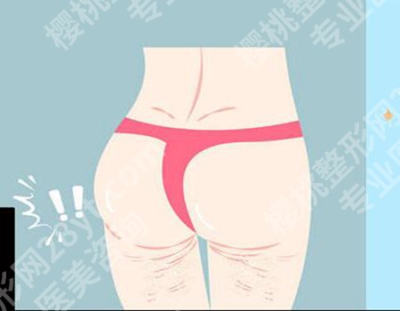 自体脂肪丰臀：一次就能拥有理想臀型吗？戳进来详细看