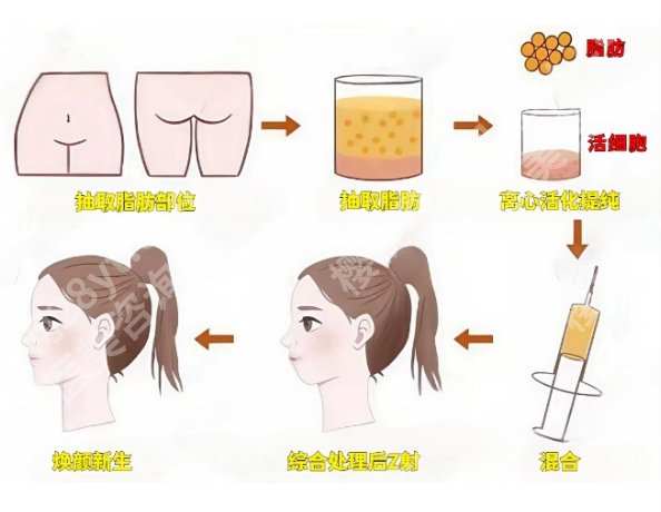 八大处自体脂肪填充全脸哪个医生好？医生擅长多种项目！