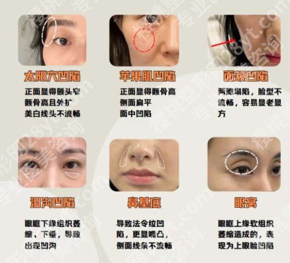 山东省立医院脂肪填充价格贵吗？项目收费明细展示！