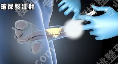 上海九院玻尿酸增粗费用价格明细表一览!医院设备及技术水平!